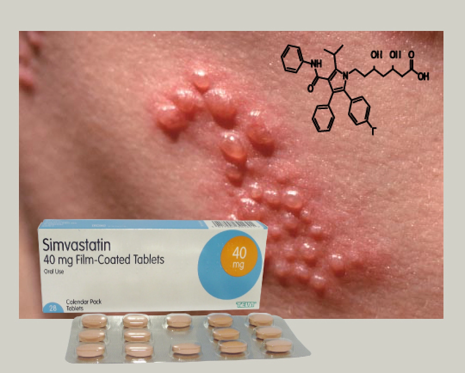 A Pox on Cholesterol Lowering Drugs: Statins Raise Herpes Zoster (Shingles) Risk