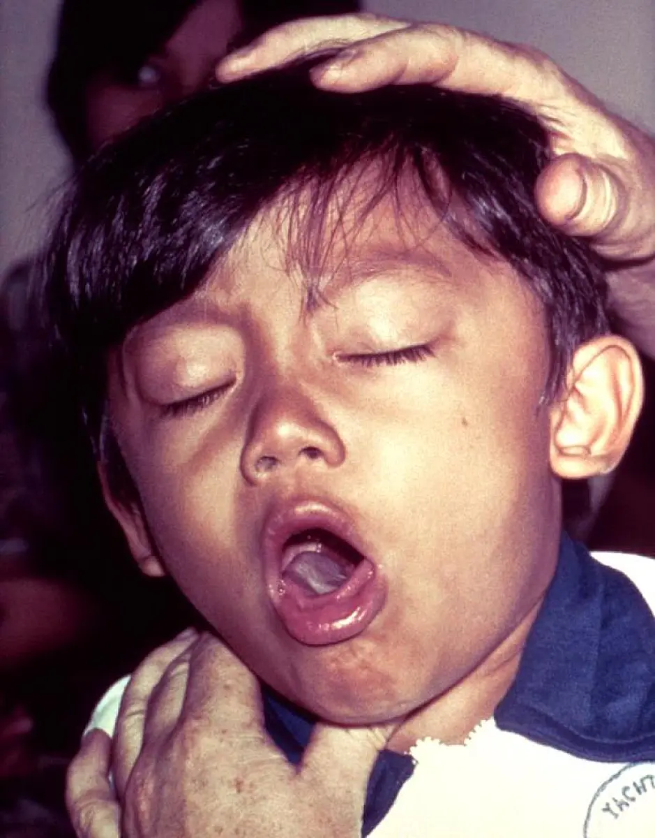 Those Vaccinated With The Pertussis Vaccine Are Spreading Disease