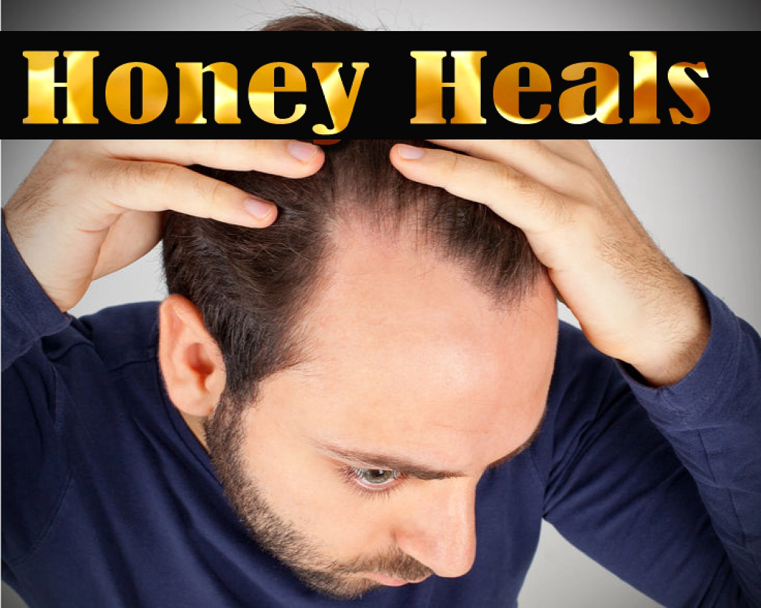 Honey Heals Chronic Dandruff, Scaly, Itchy Scalp (Seborrheic Dermatitis)
