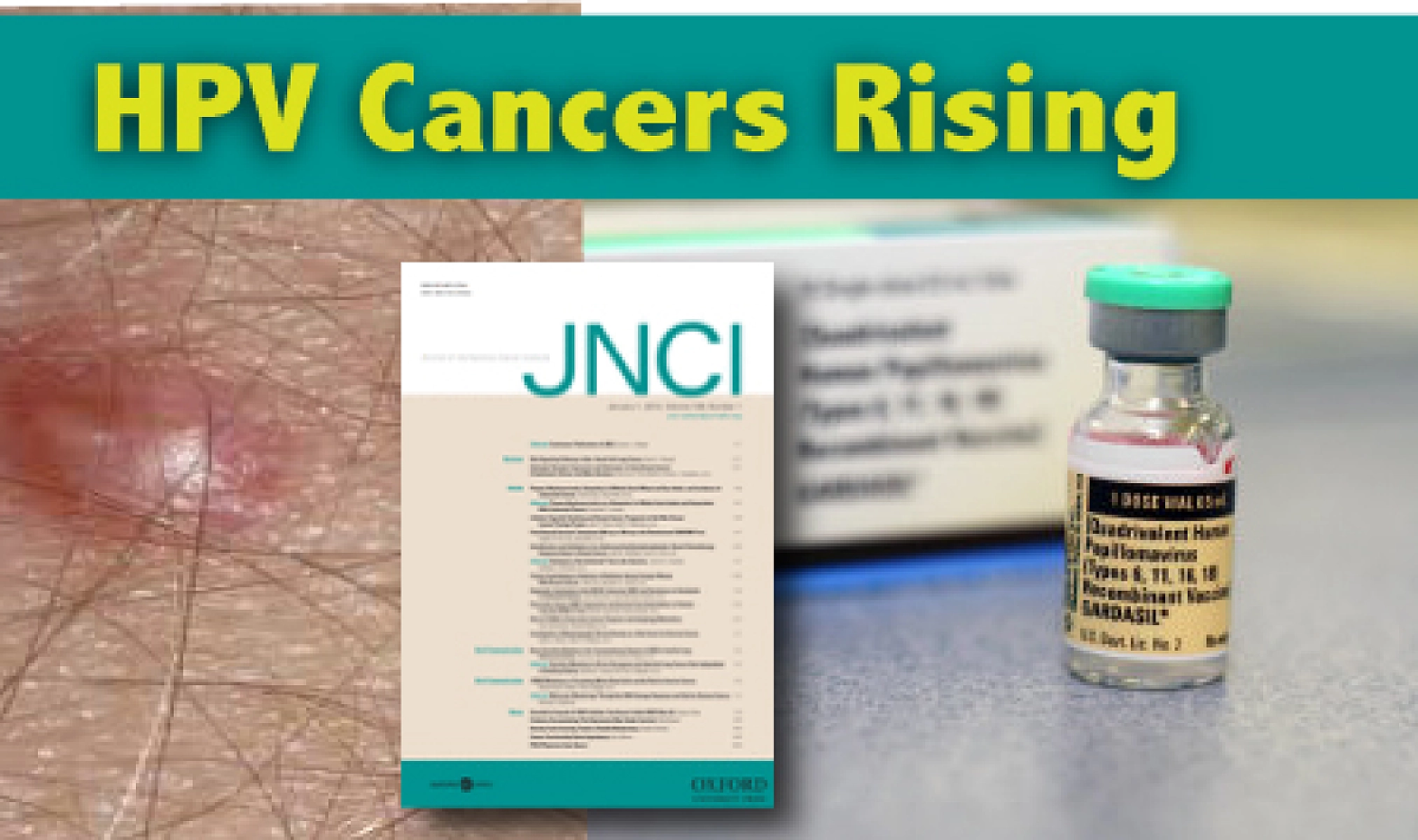 Breaking Report: HPV Cancers Rising In Spite of Vaccination