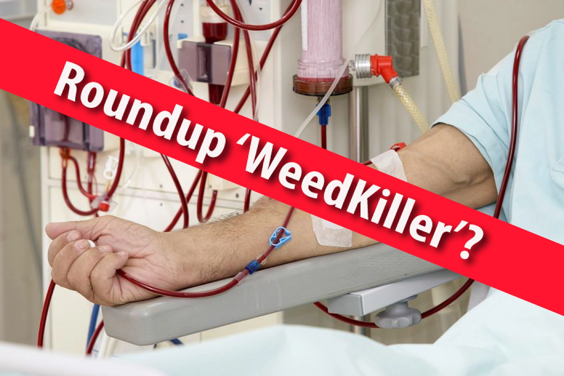 Dramatic Increase in Kidney Disease in the US and Abroad  Linked To Roundup (Glyphosate) 'Weedkiller'