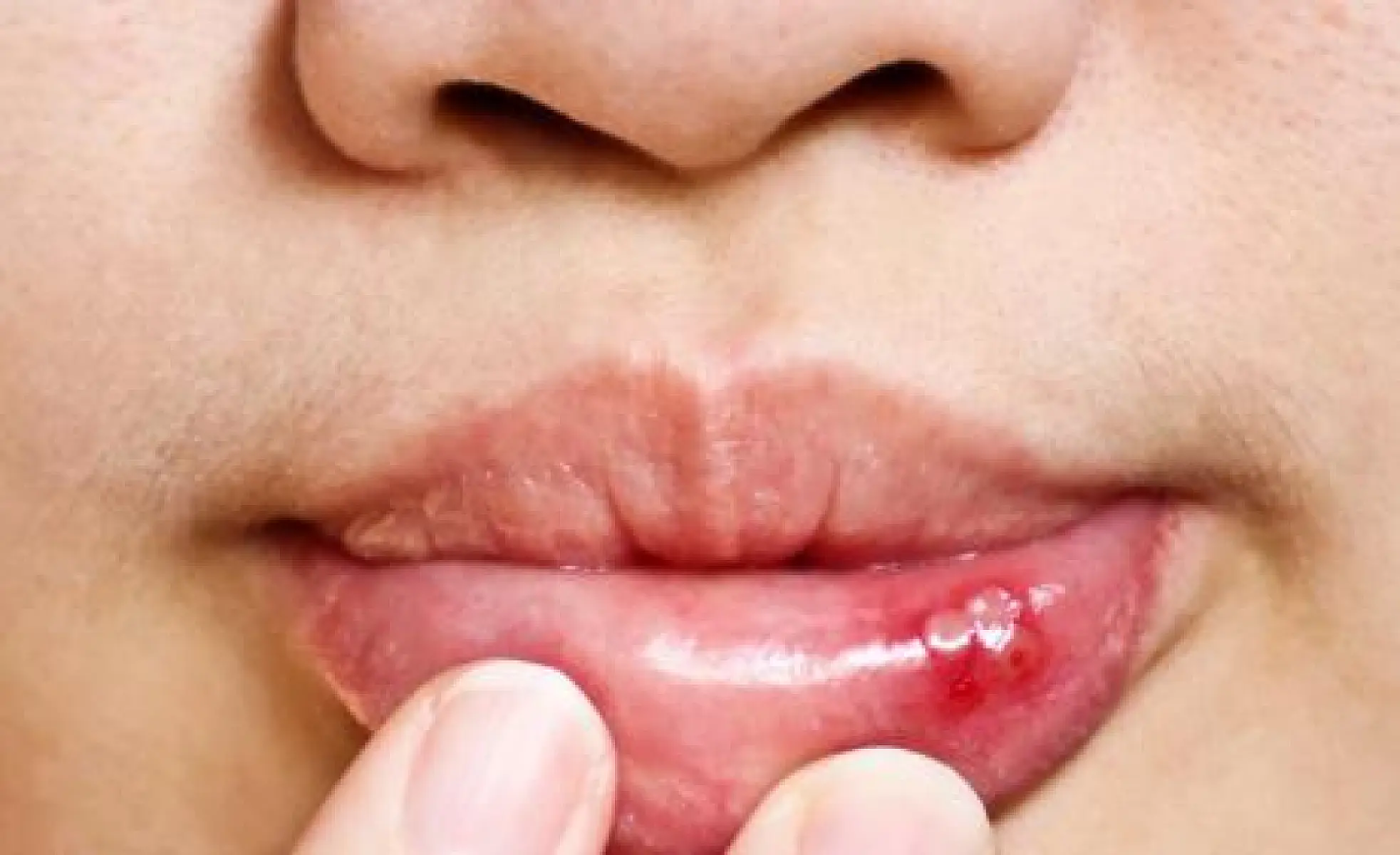 7 Natural Ways to Ease Canker Sores