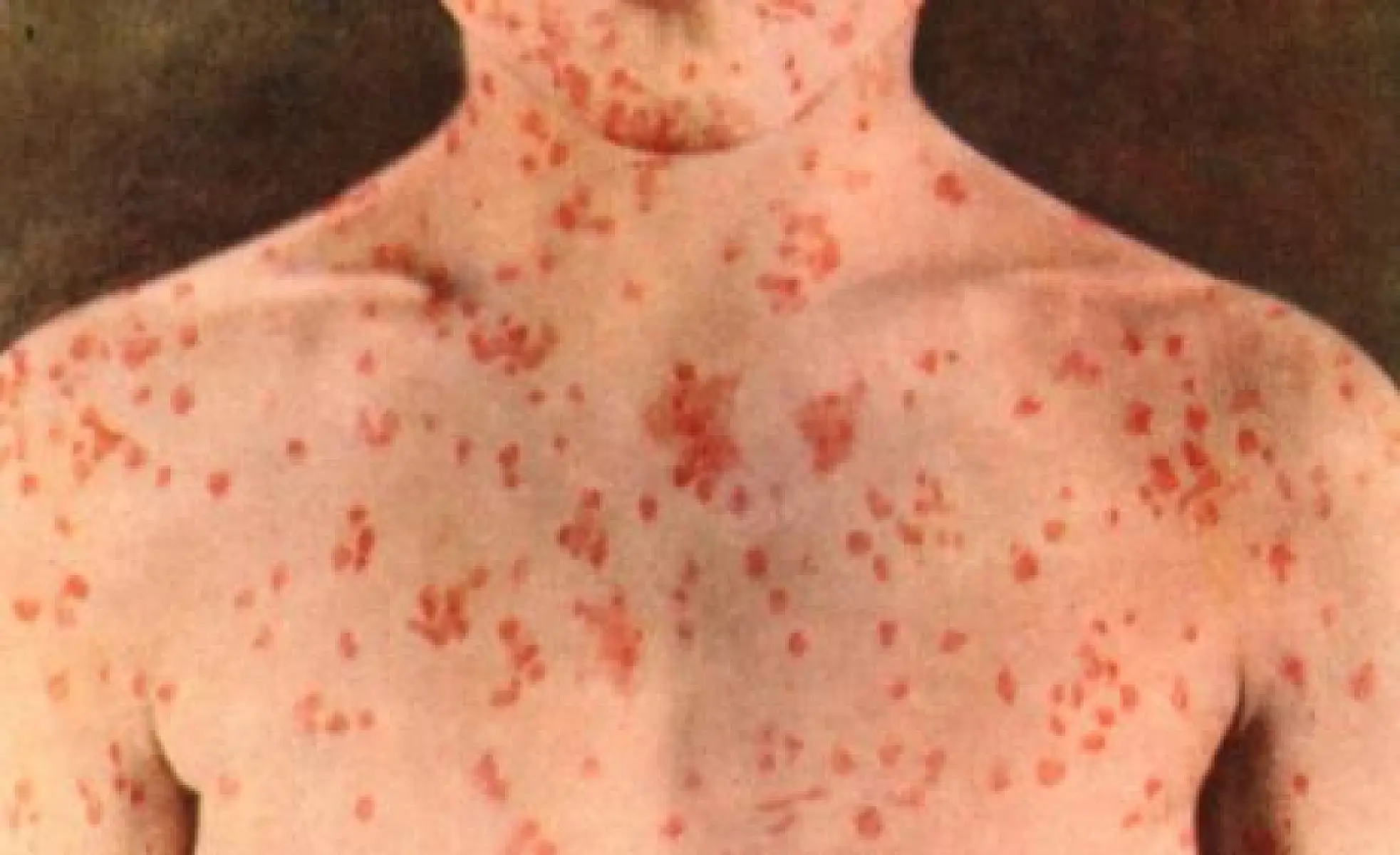 Outbreaks of Measles: Should We Be Concerned?