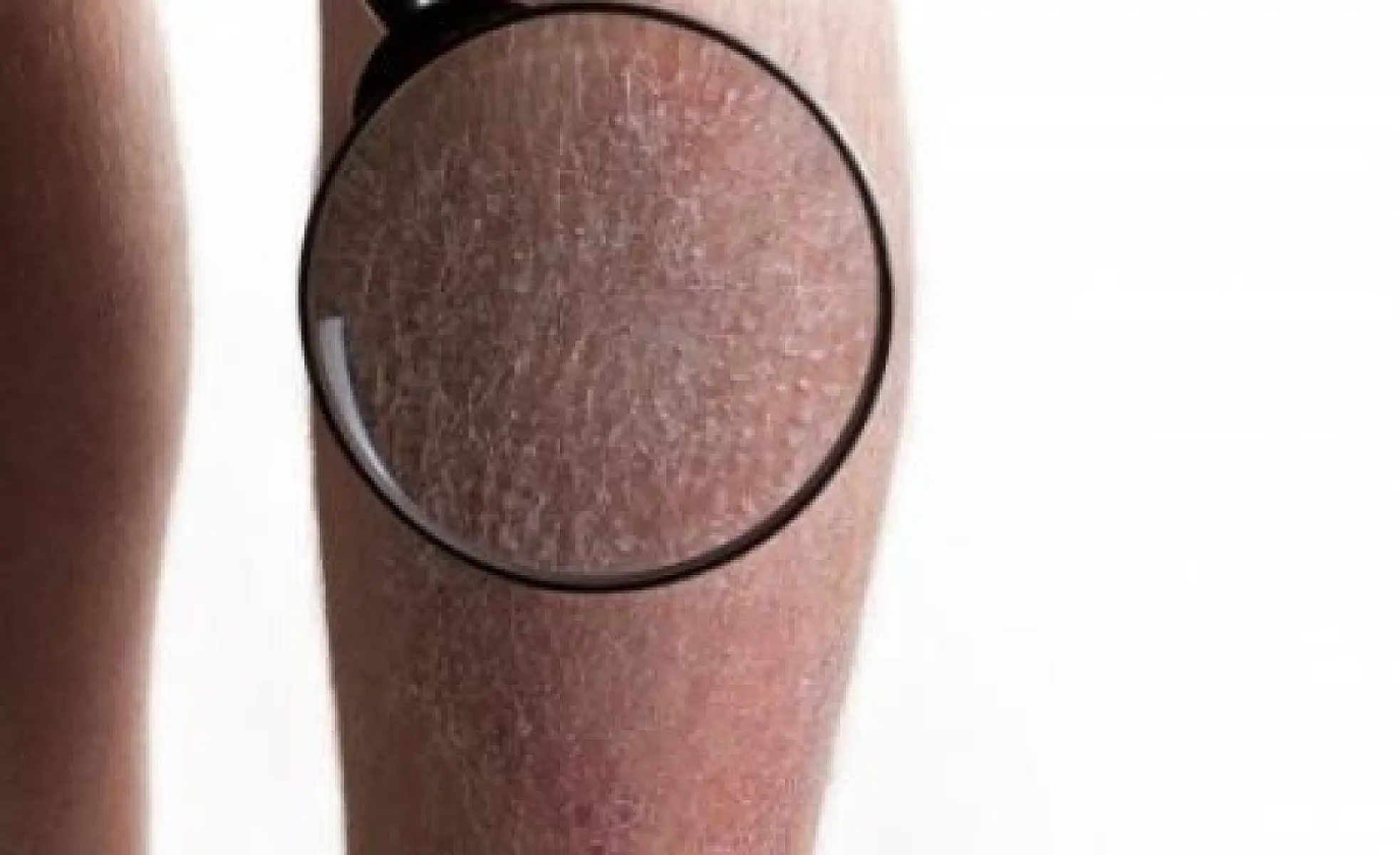 Morgellons Disease, the Mysterious Skin Disease 