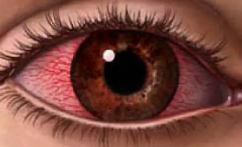 Natural Remedies for Pinkeye (Conjunctivitis)