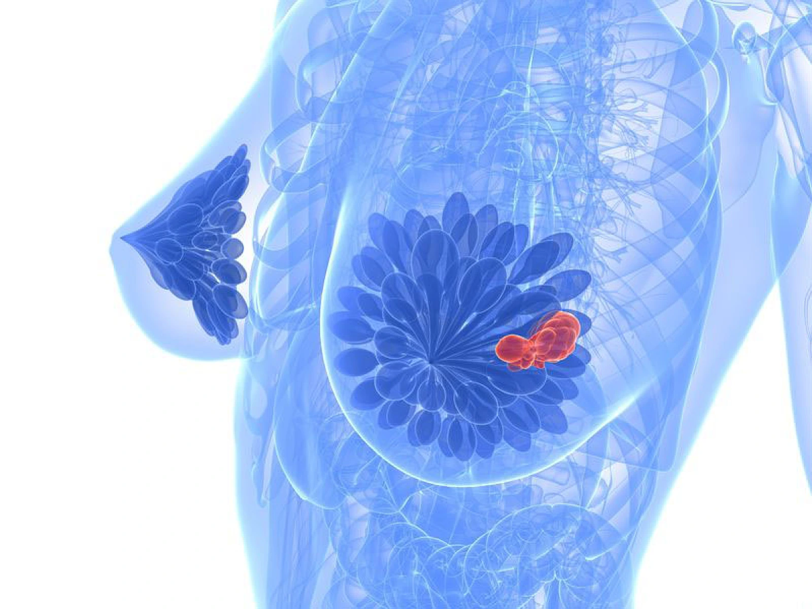 Thermography is Key for Early Detection of Breast Cancer
