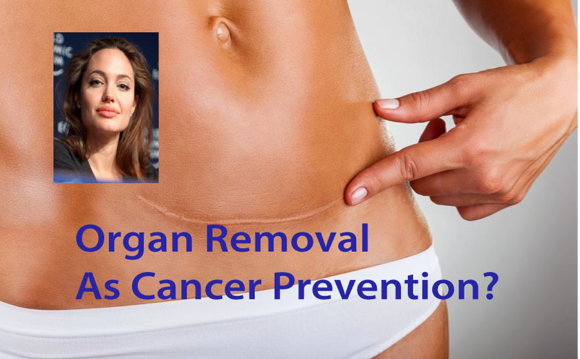 Beware of Organ Removal for "Cancer Prevention": Jolie's Precautionary Tale