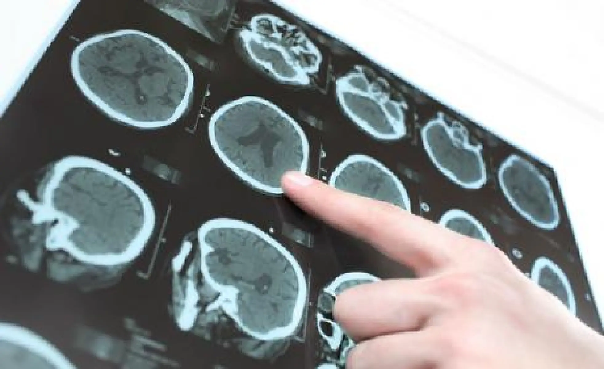 Taking Calcium Supplements Causes Brain Lesions