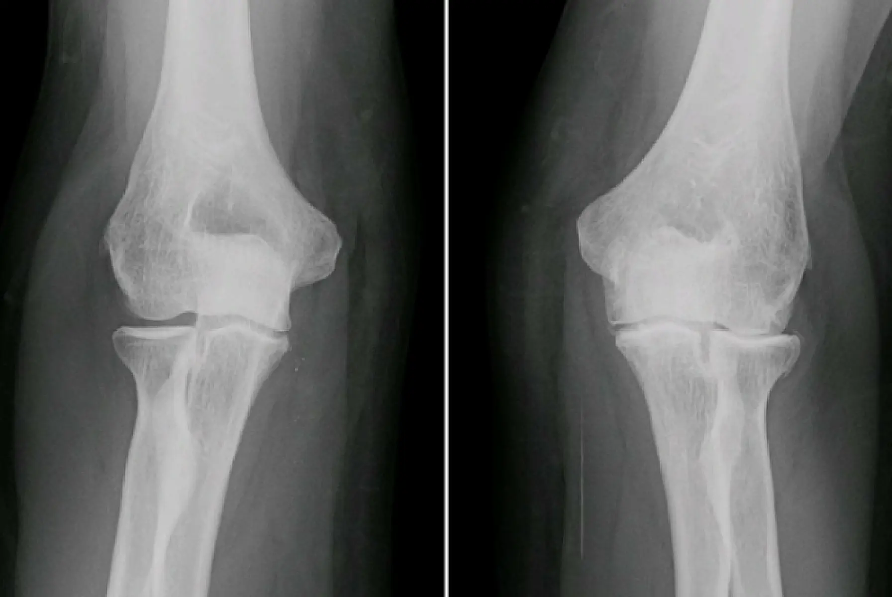 Study: Knee Surgery No Better Than Placebo