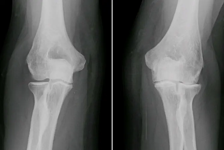 Study: Knee Surgery No Better Than Placebo