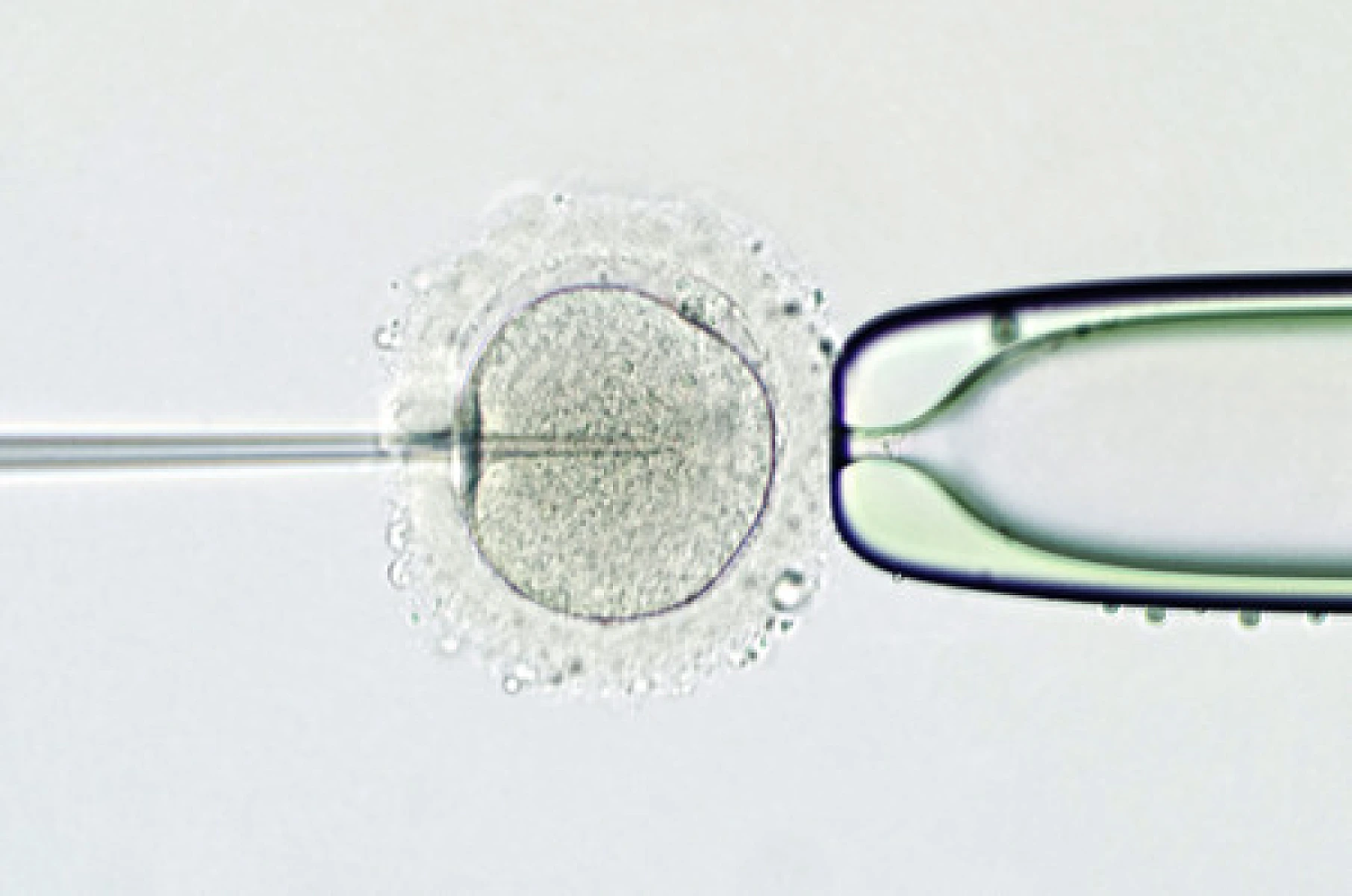 Stem Cell Transplant: Bone Marrow Derived