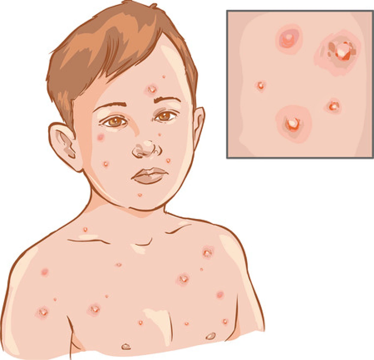 Cataractogenic