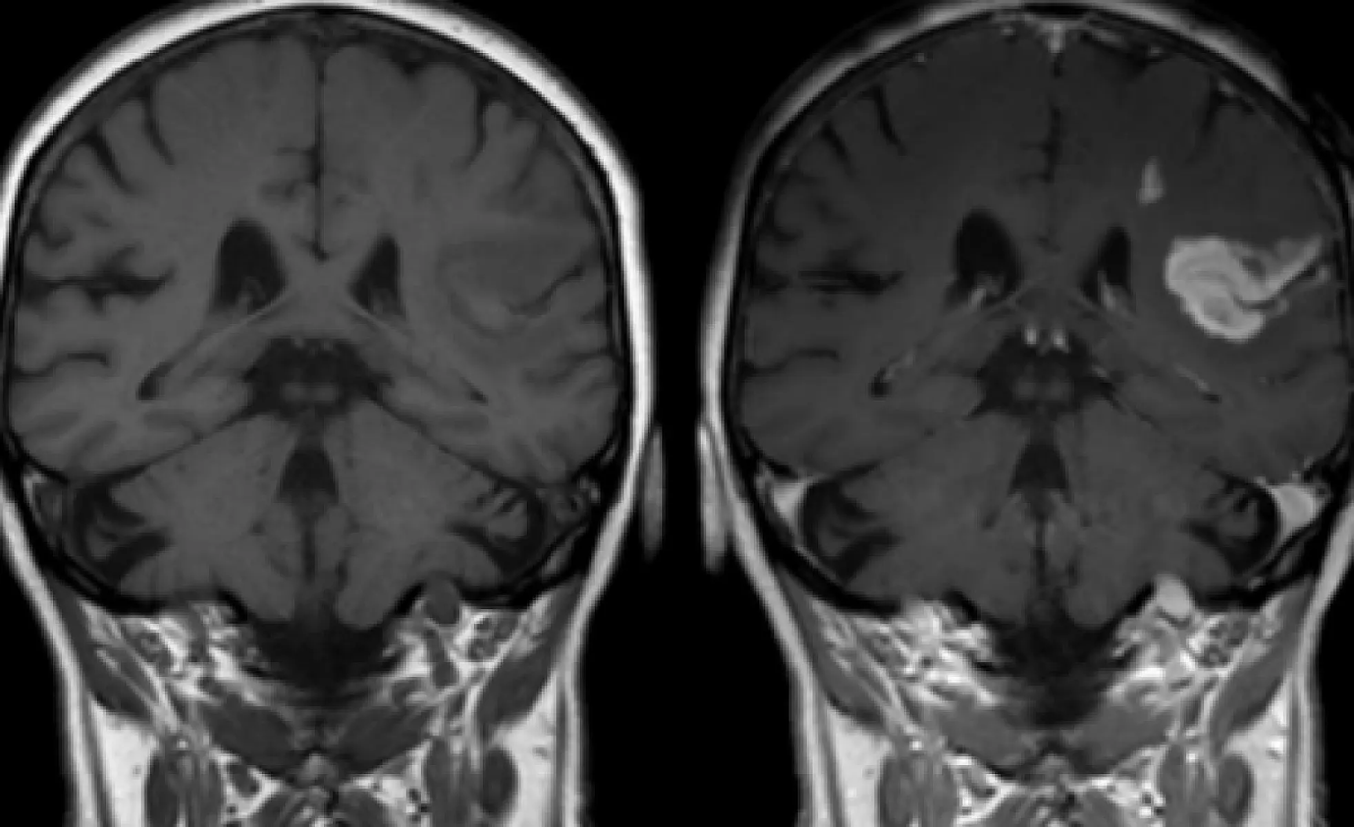 9 Foods to Cut Your Risk of a Deadly Stroke