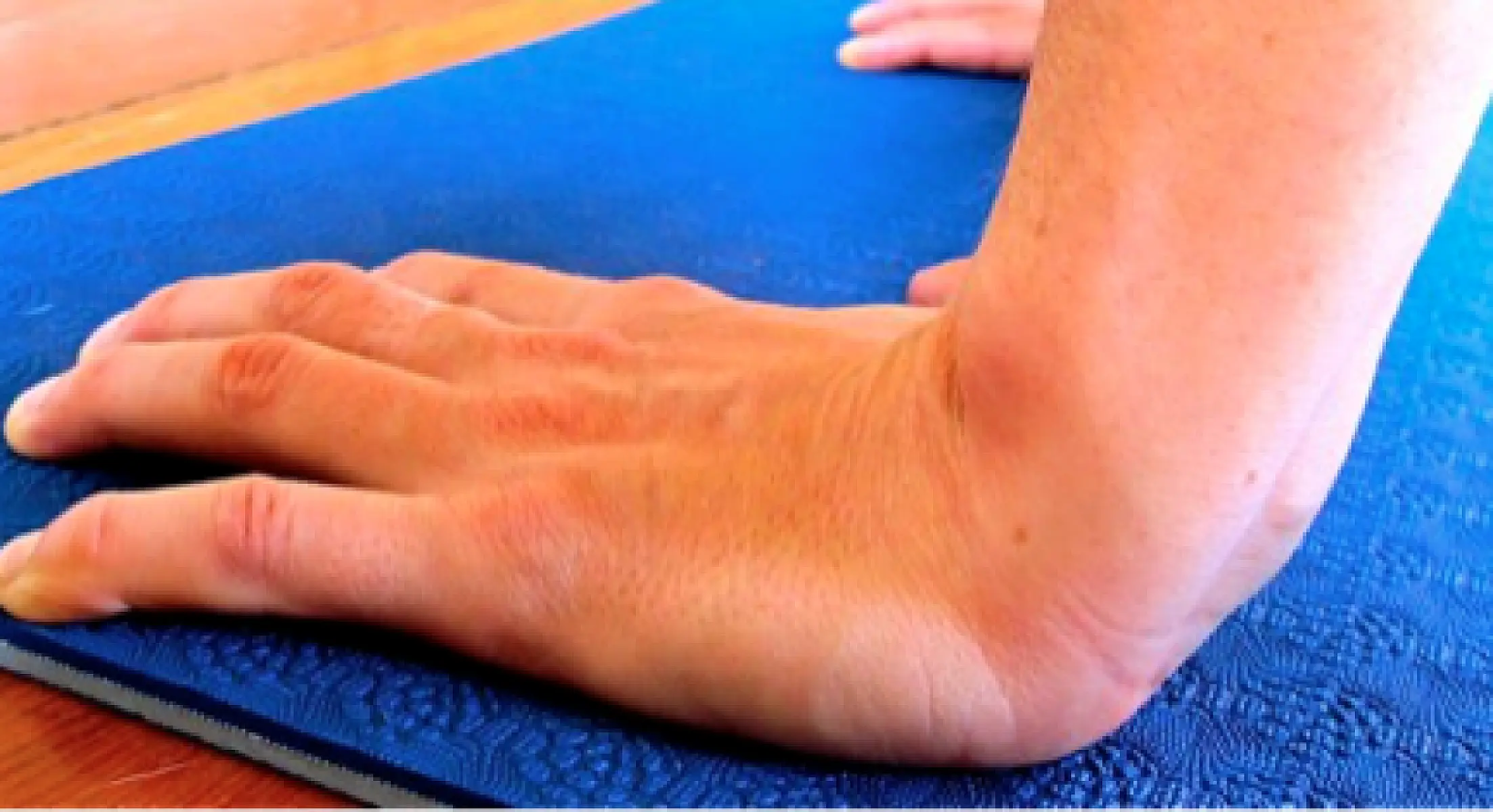 Everyone and No One Has Carpal Tunnel