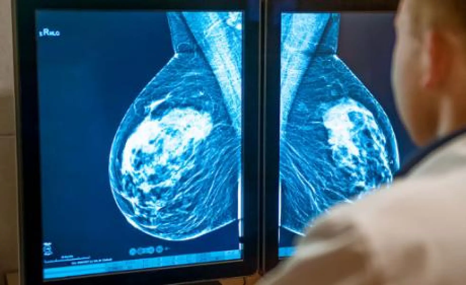 Study: Many Breast Tumors Will Spontaneously Regress