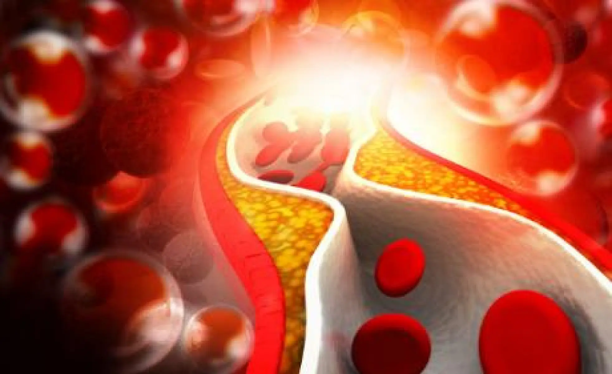 Atherosclerotic Plaque as Infected Biofilm