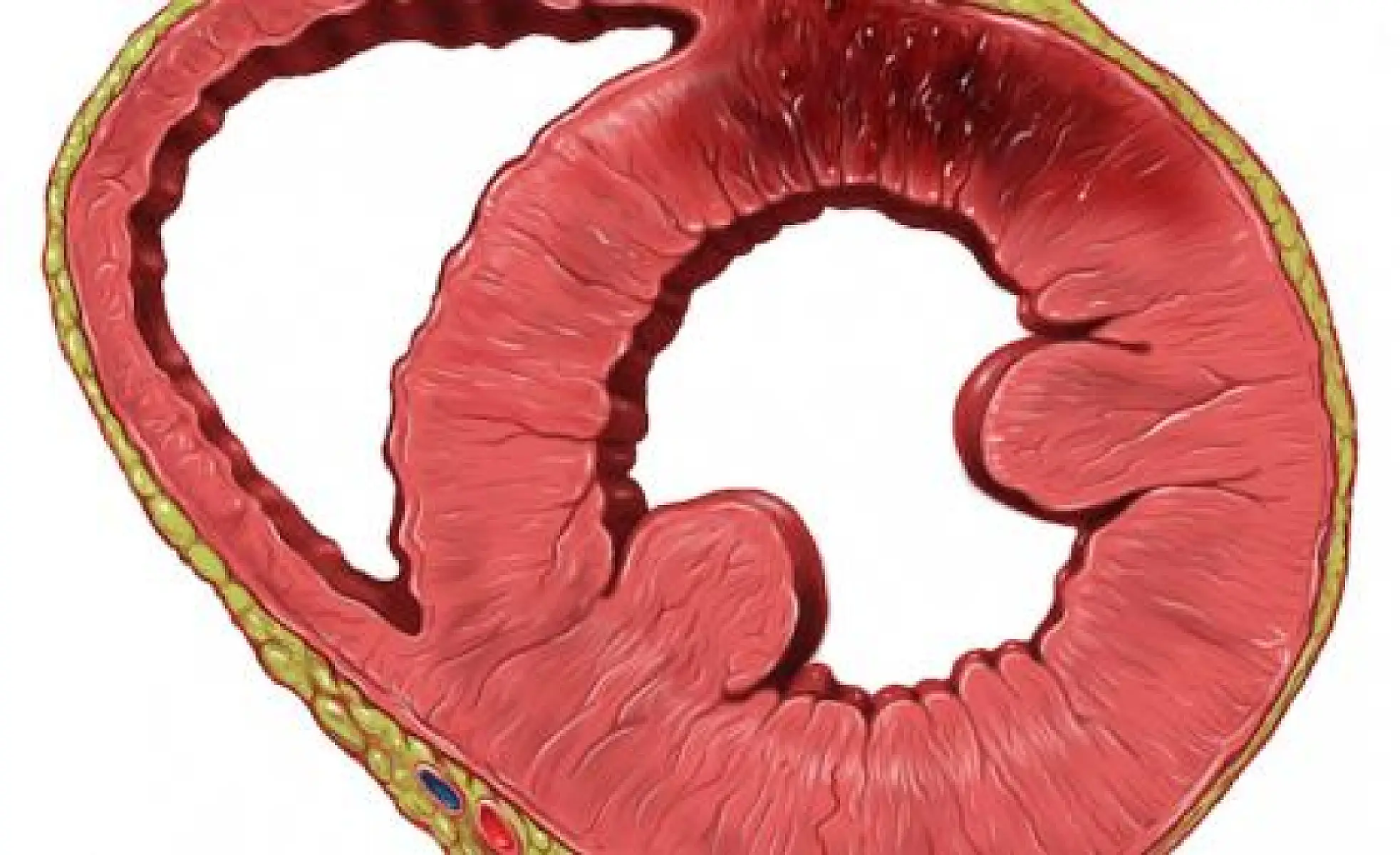 How to Reverse Heart Disease with the Coronary Calcium Score