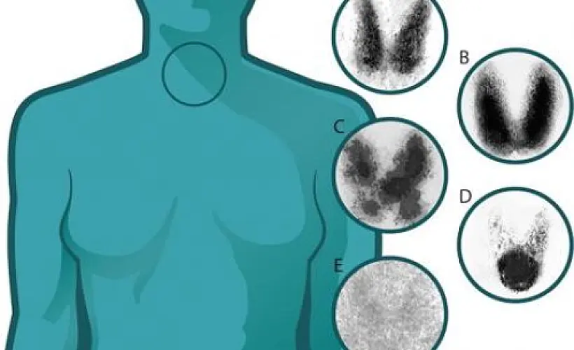 Thyroid Cancer Epidemic of Overdiagnosis