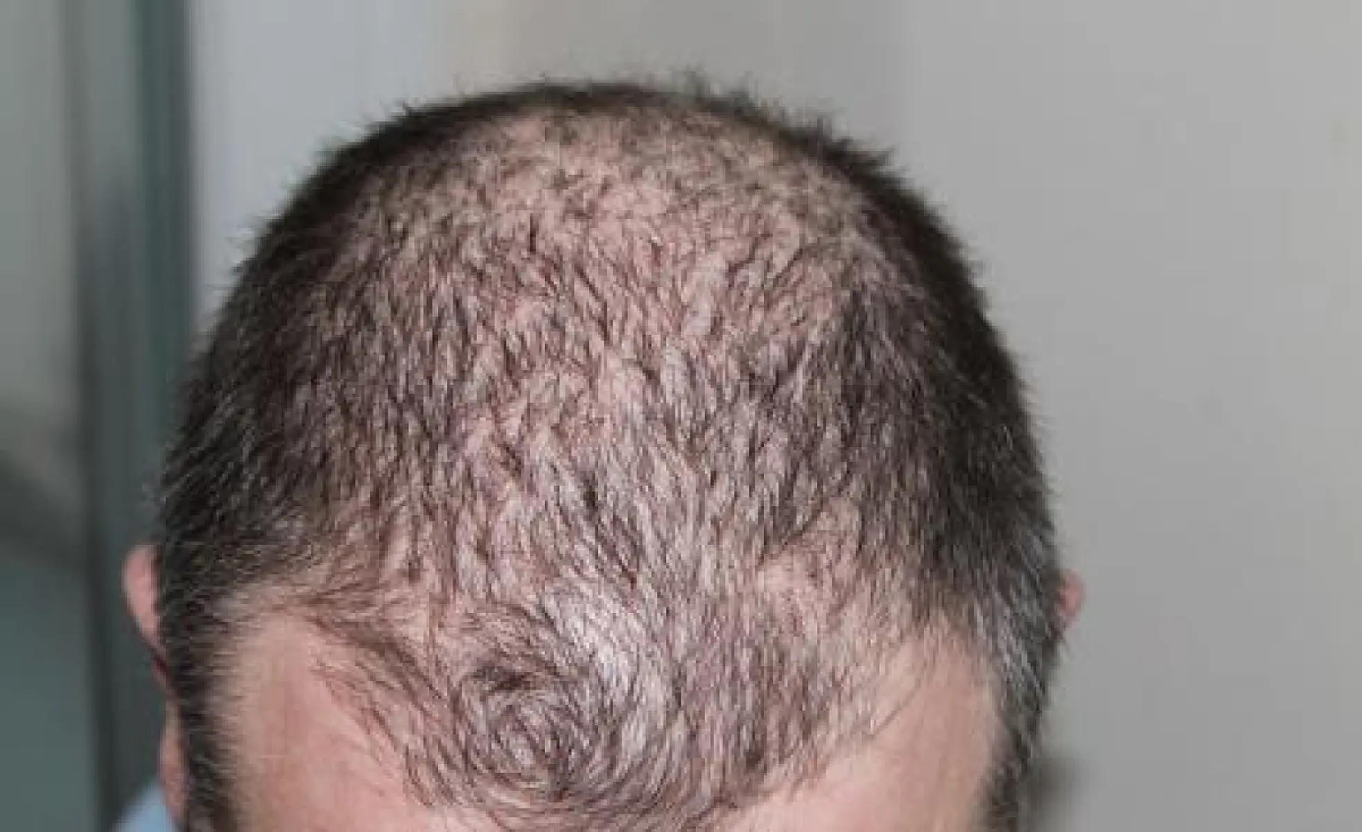 Getting to the Root of Hair Loss