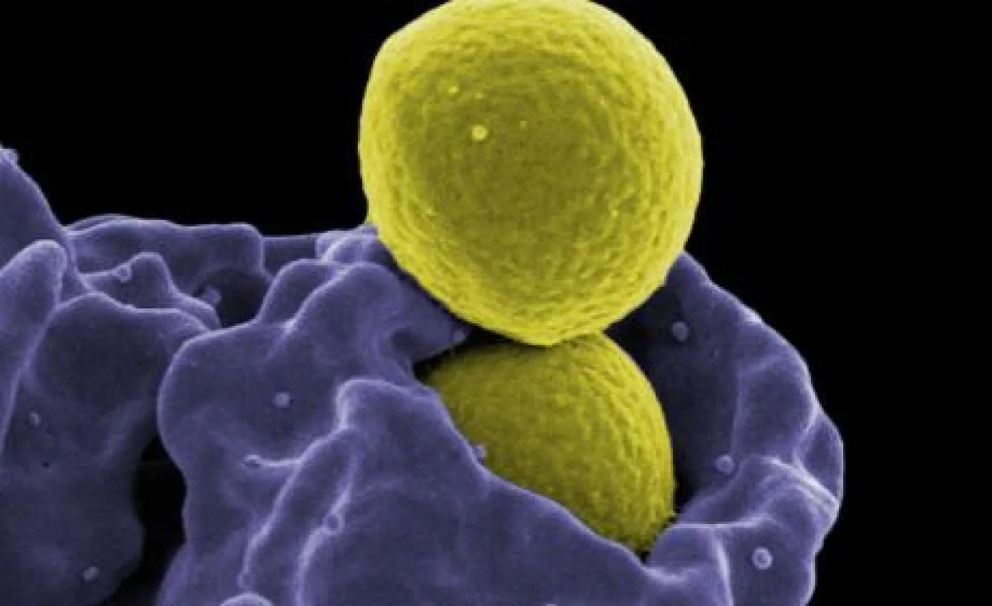 Antimicrobial Resistance - The Looming Medical Apocalypse
