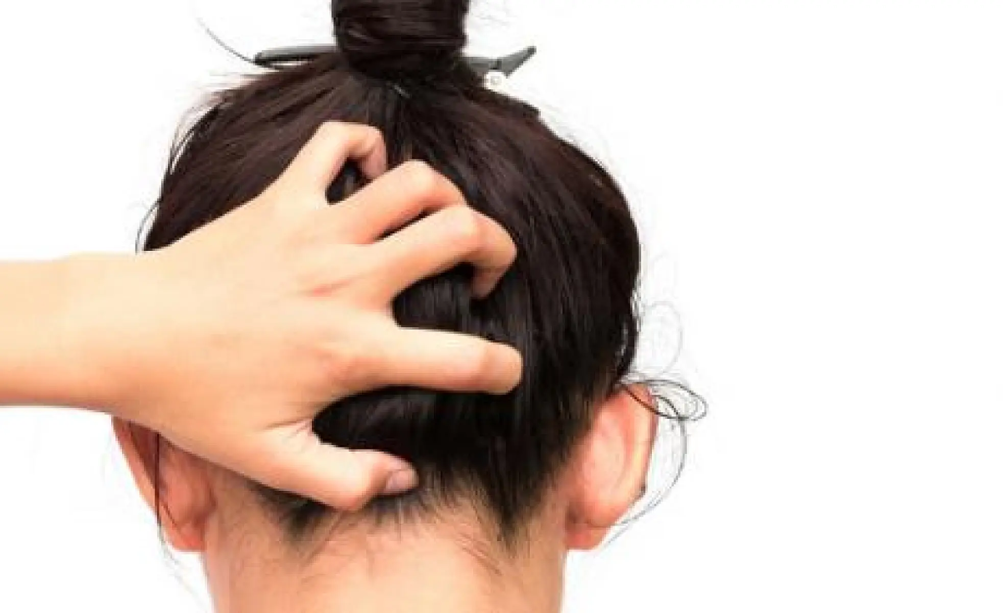 Dandruff Problems? Natural, Evidence-Based Solutions You've Probably Not Heard About