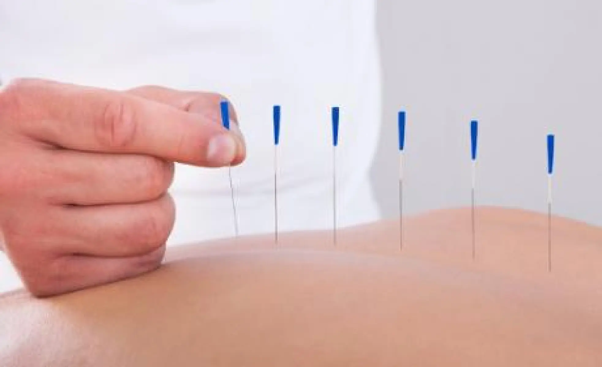Acupuncture: Calling the Defense