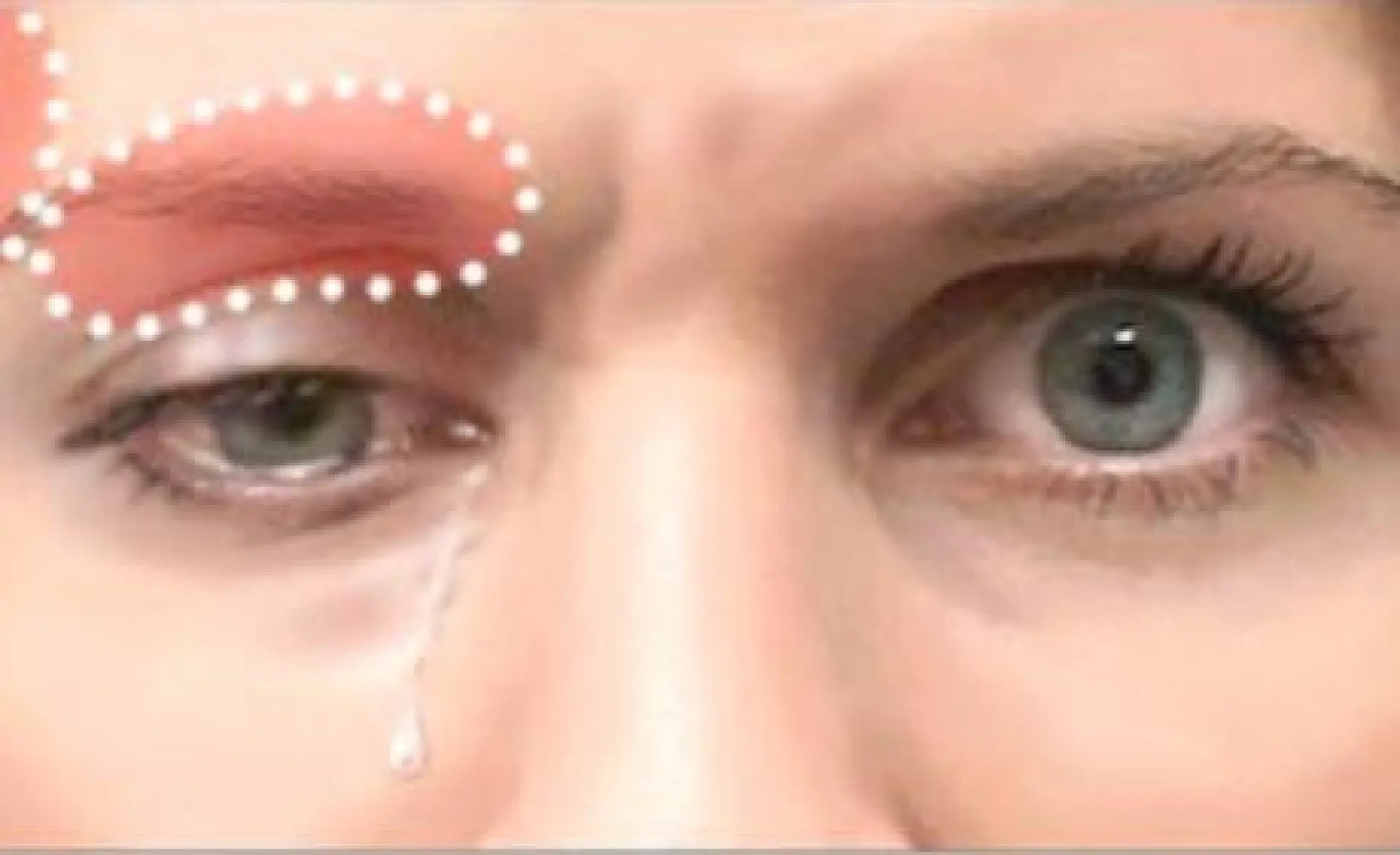 Botox’s Ugly ‘Side Effects’ Run Deeper Than Skin, Alter Mind & Numb Emotion