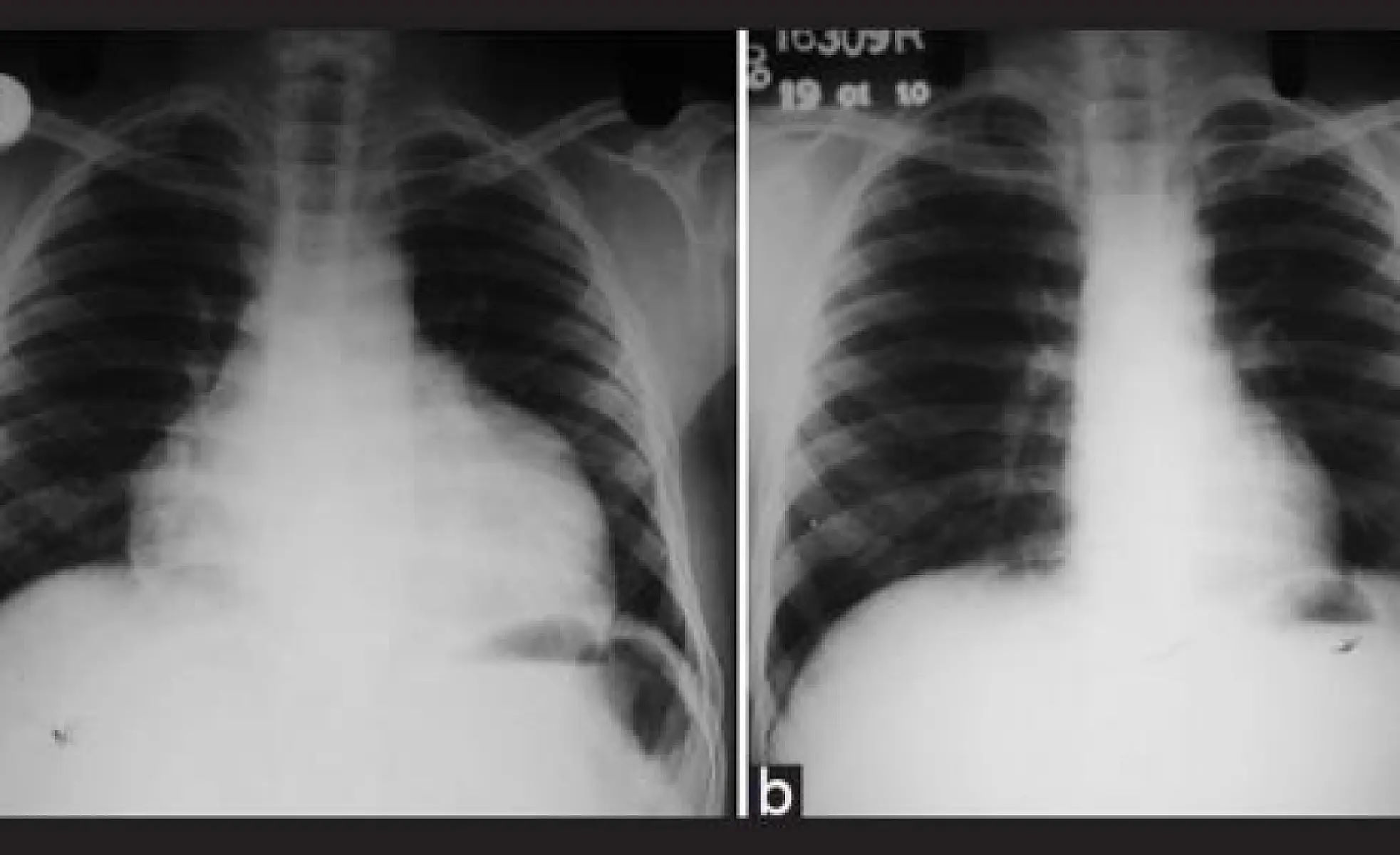 Cardiomyopathy Reversible with CoQ10 and Selenium