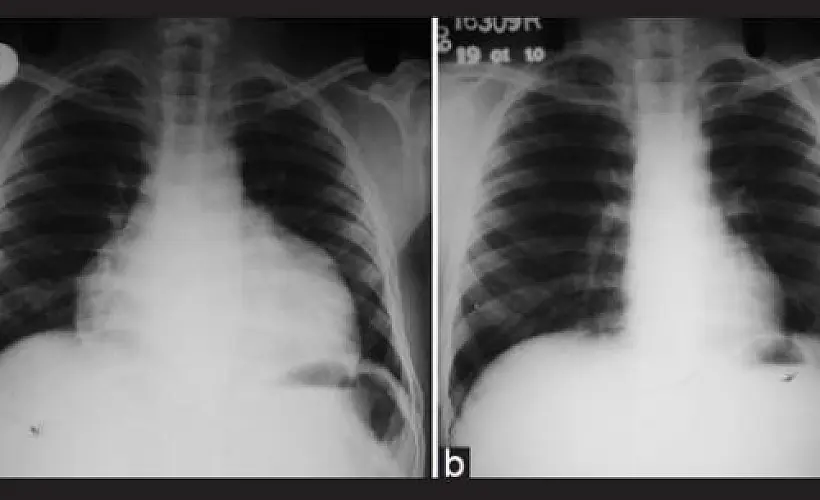 Cardiomyopathy Reversible with CoQ10 and Selenium