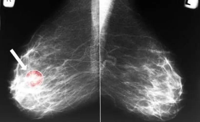 Yes, Breast Cancer Can (And Often Does) Spontaneously Regress: Confirmed by Case Reports and Meta-Analyses