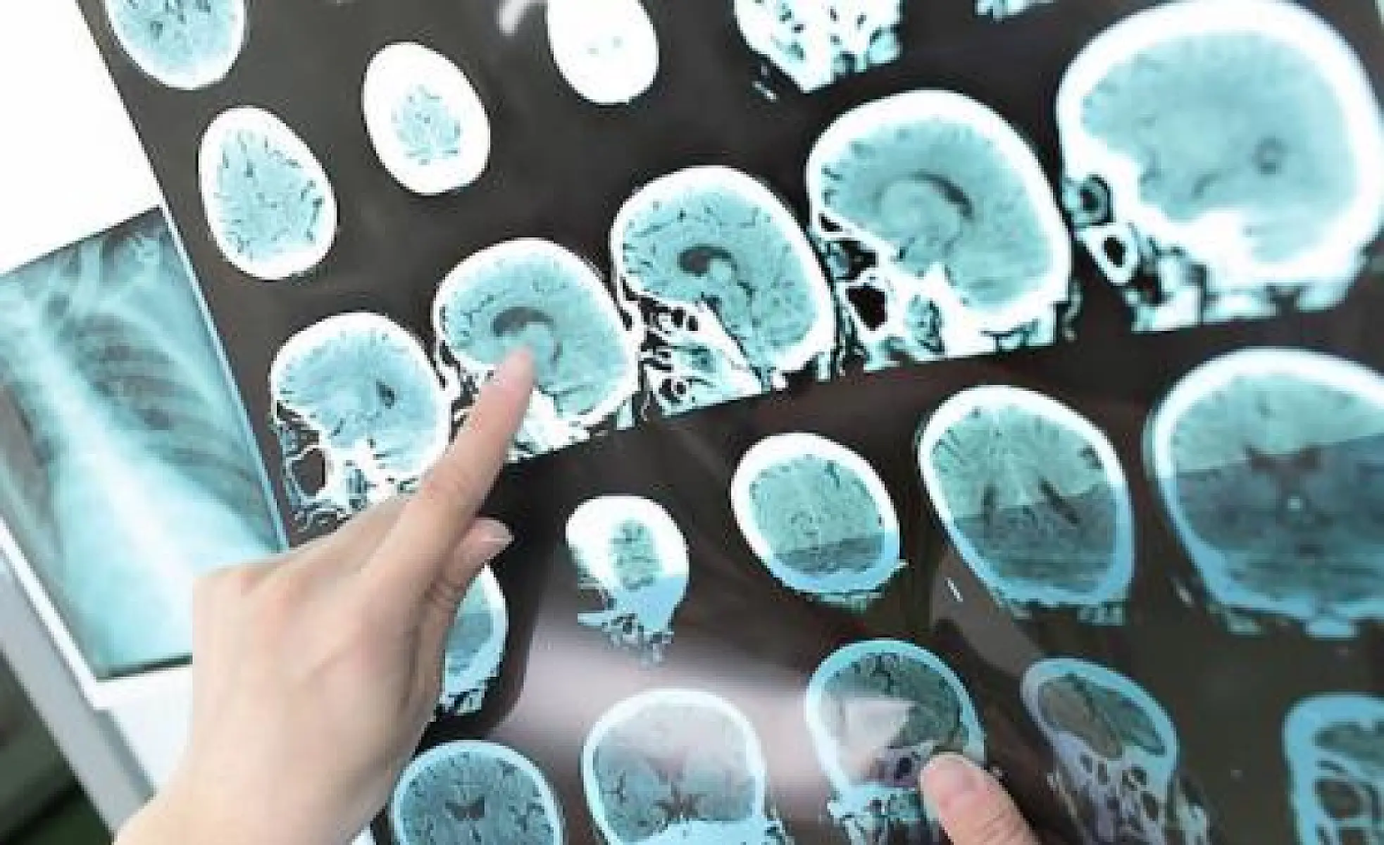 Alpha-Lipoic Acid Improves Multiple Sclerosis