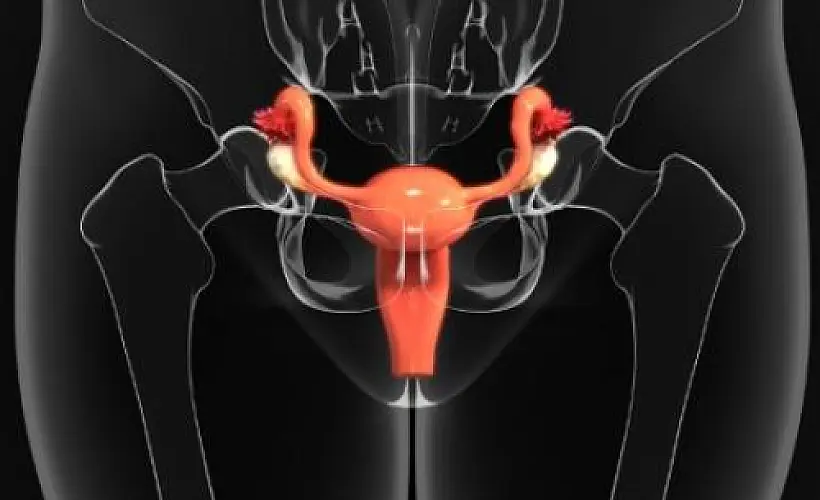 Recipe to Annihilate VBAC Uterine Rupture