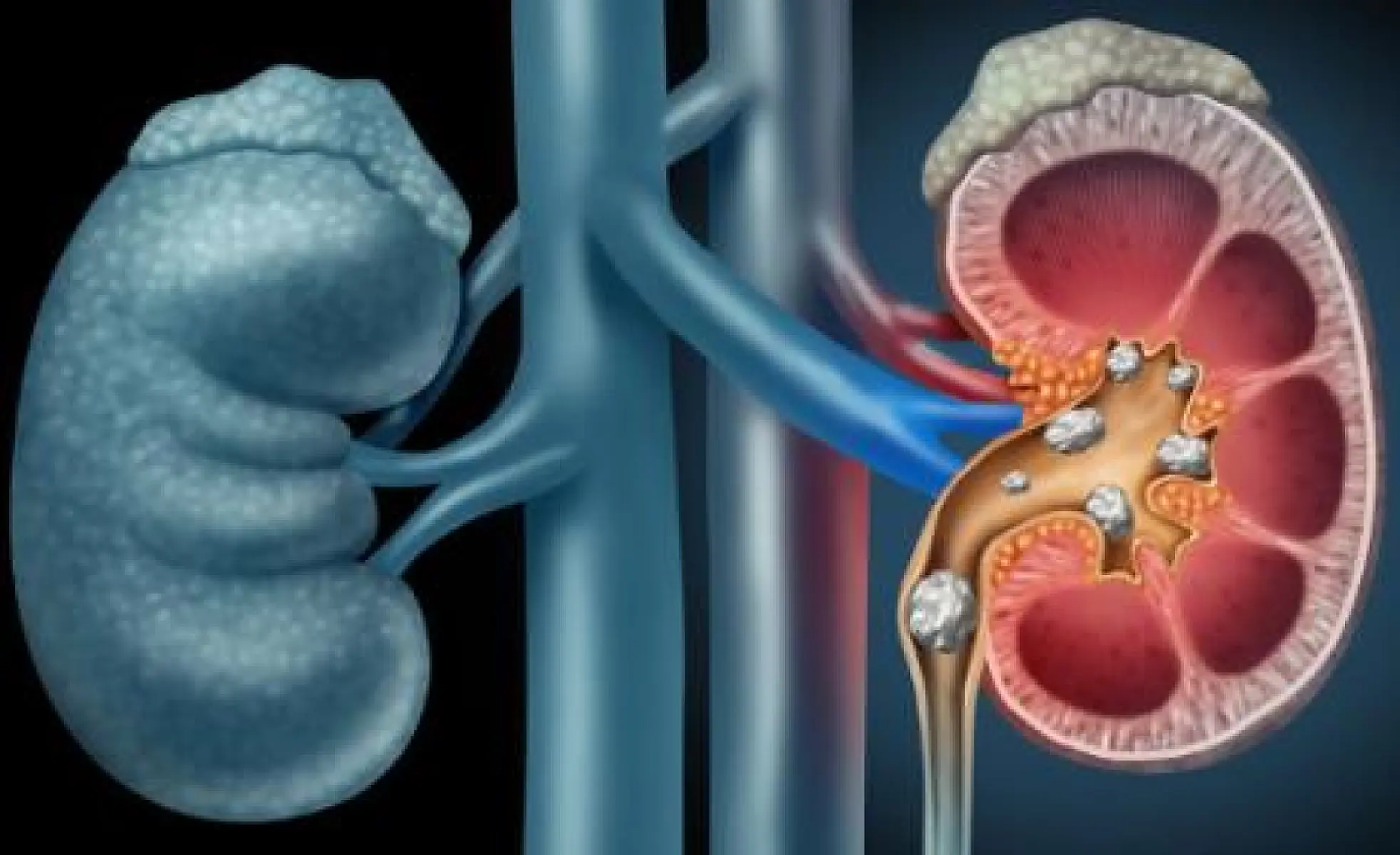 Ground Black Seed May Dissolve Kidney Stones