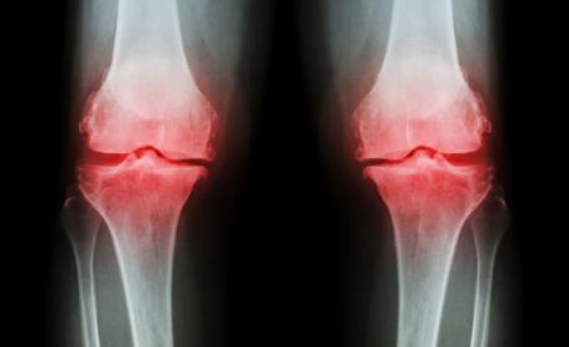 Boswellia Serrata and Bromelain Extracts Useful in Mitigating Osteoarthritis Symptoms