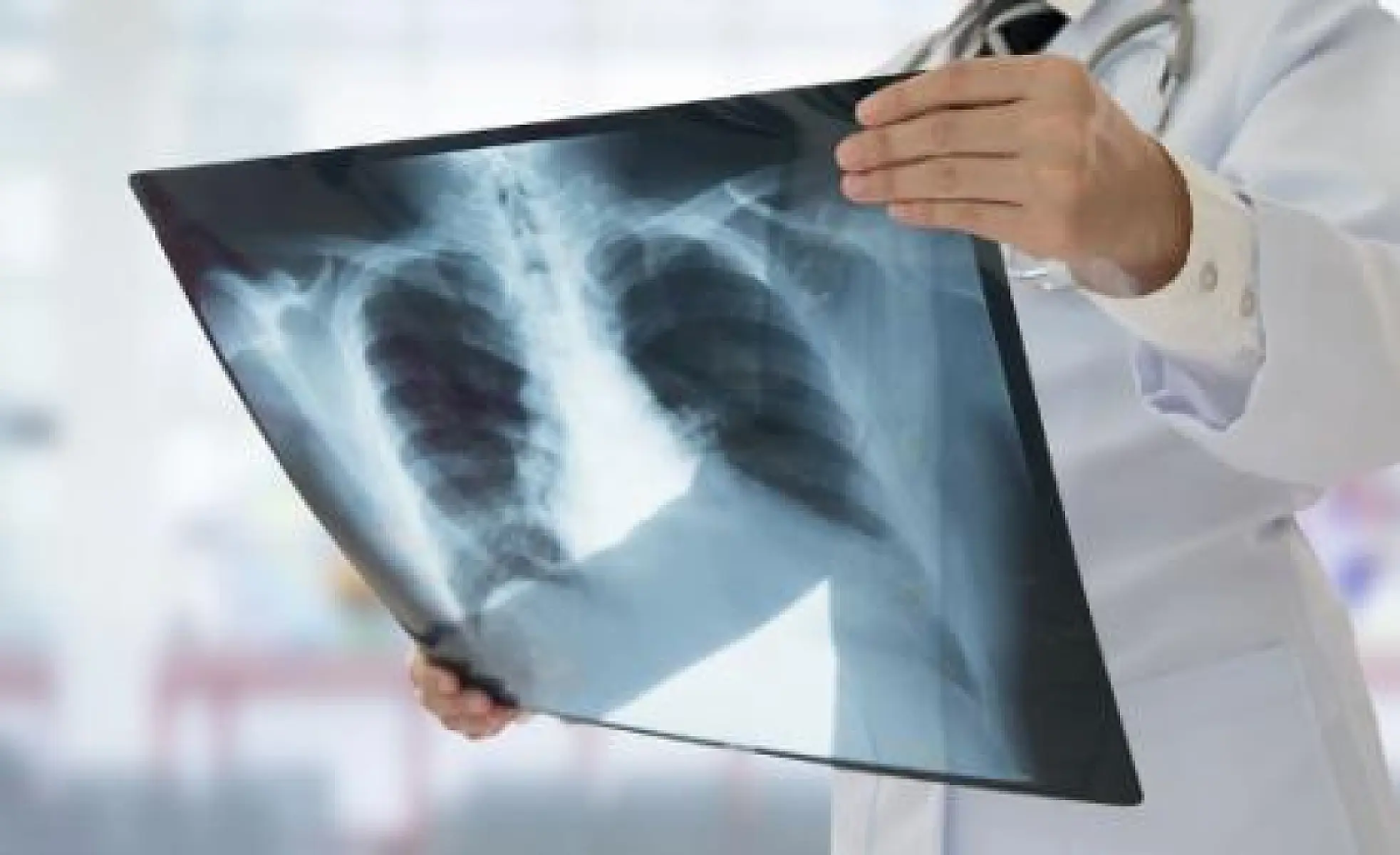 The Overdiagnosis of Cancer