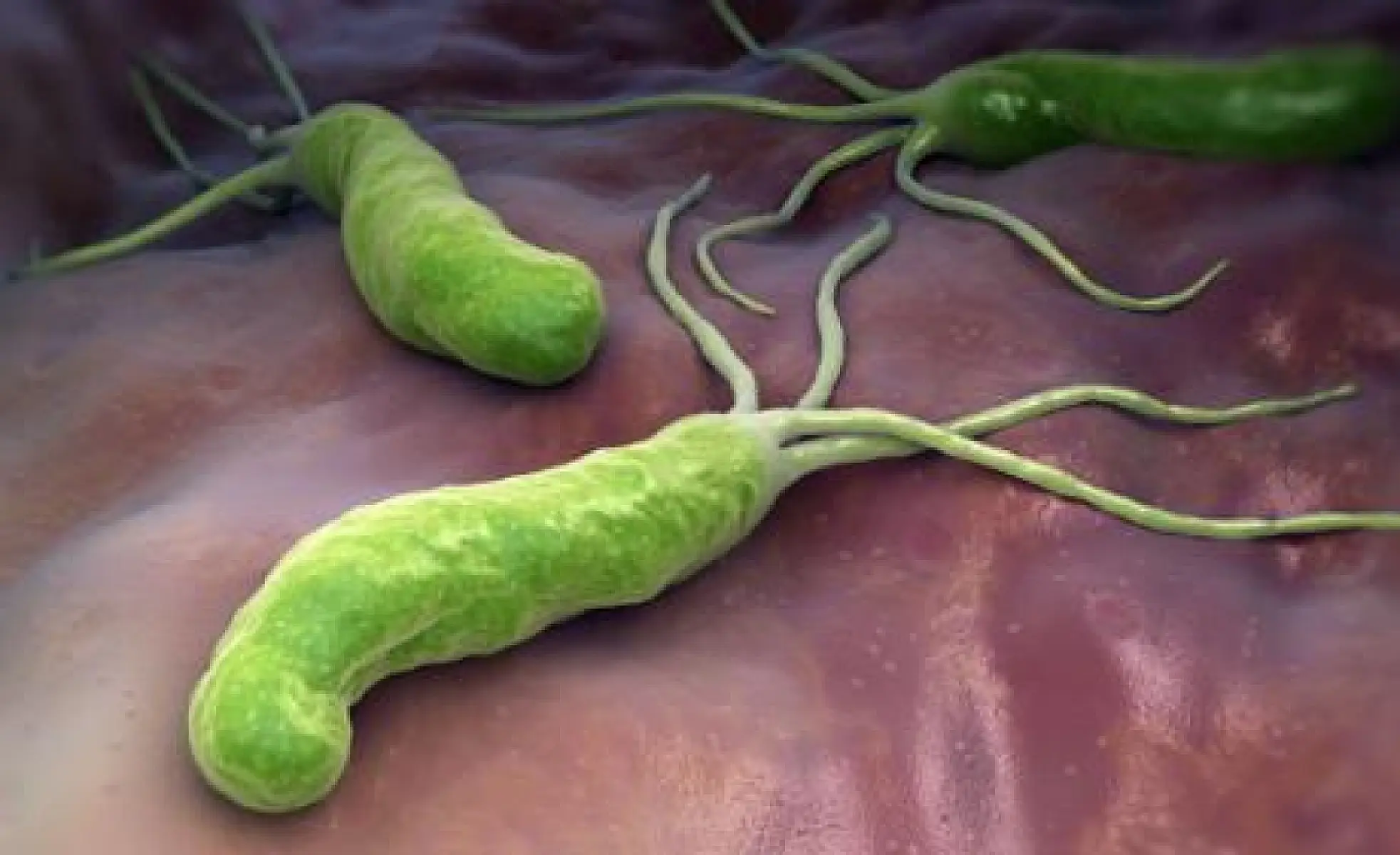 H. Pylori Treatment, Garlic and Vitamin Supplementation Slash Gastric Cancer Incidence and Death