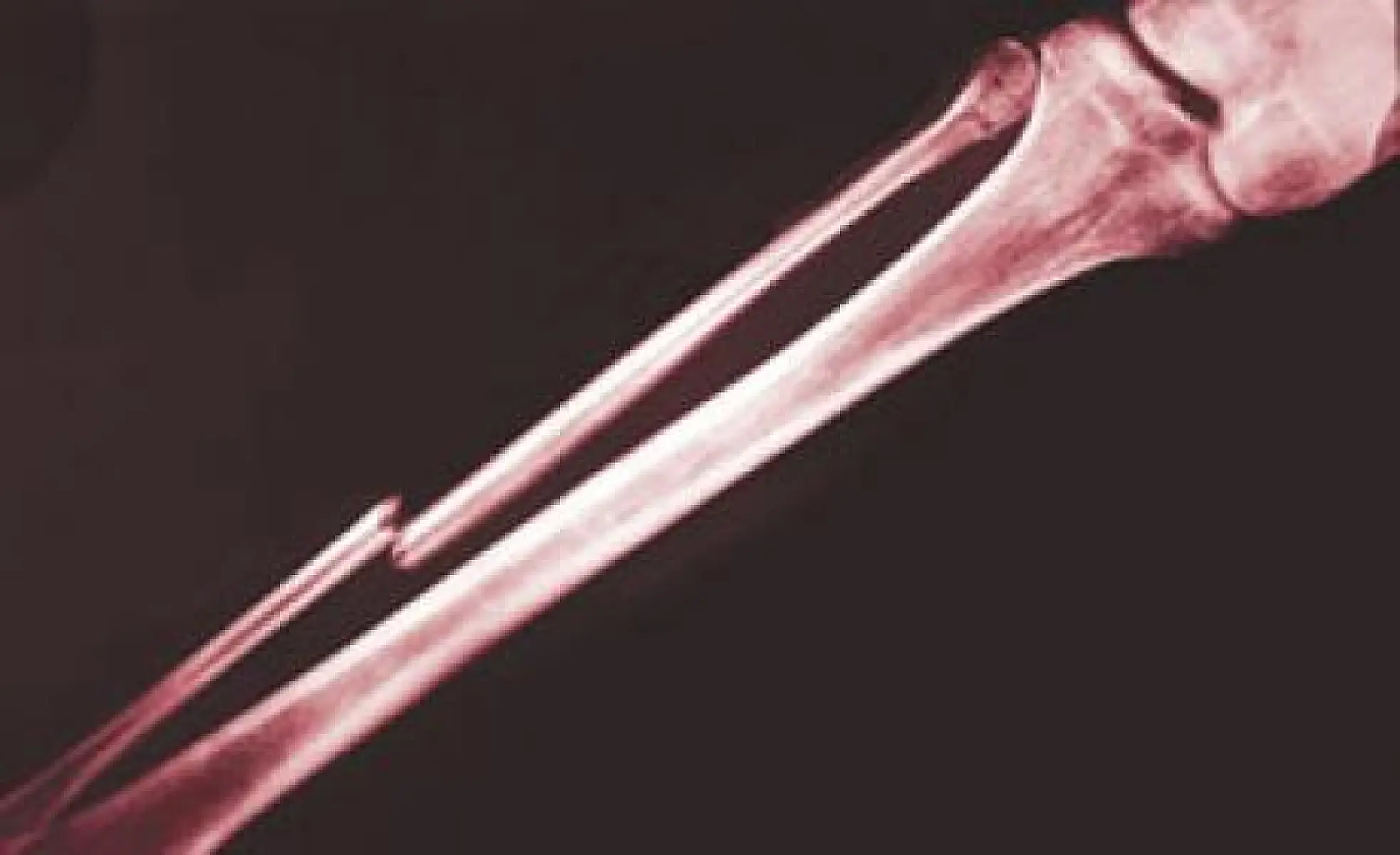 How Too Much Calcium Can Break Your Bones