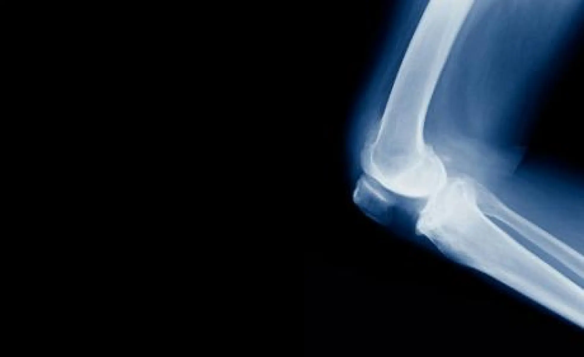 Taking Bone Meds? They Increase Your Risk of This Type of Fracture