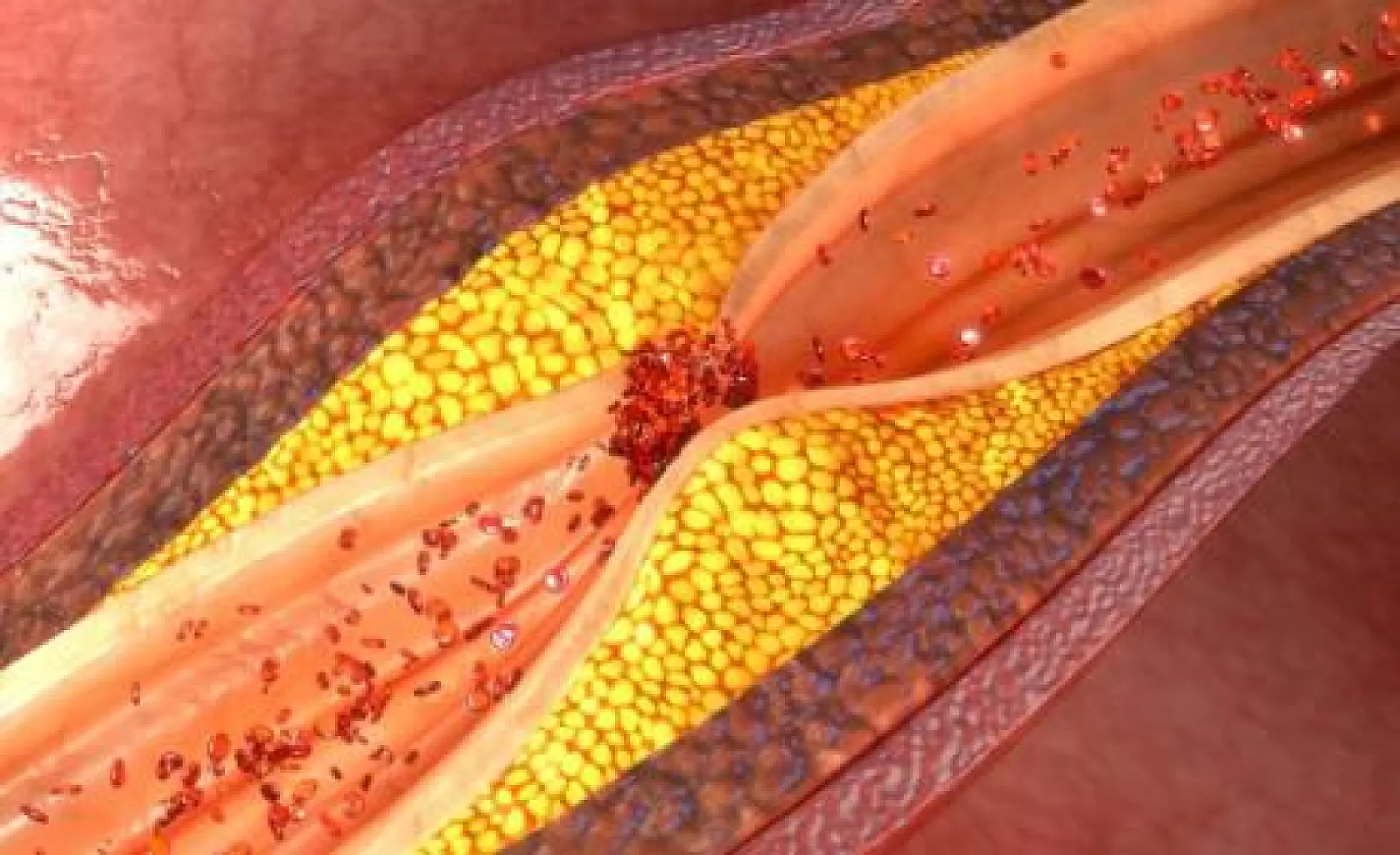 Clogged Arteries? Five Ways Garlic Can Help