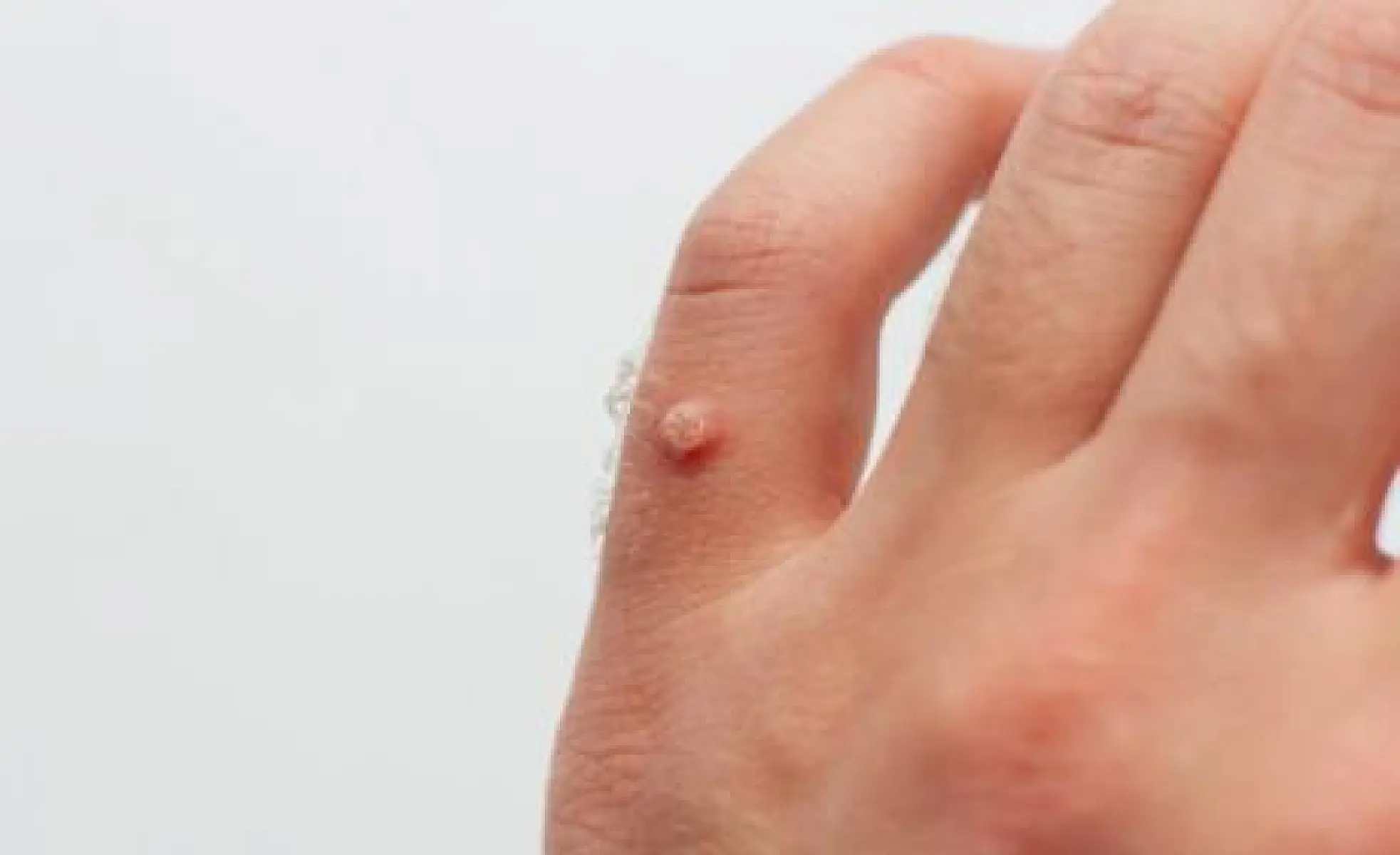 Natural Remedies to Get Rid of Warts