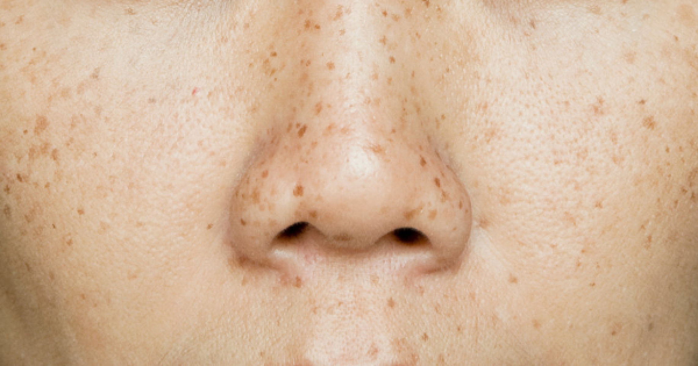 Lost Your Sense of Smell? 6 Remedies for Anosmia