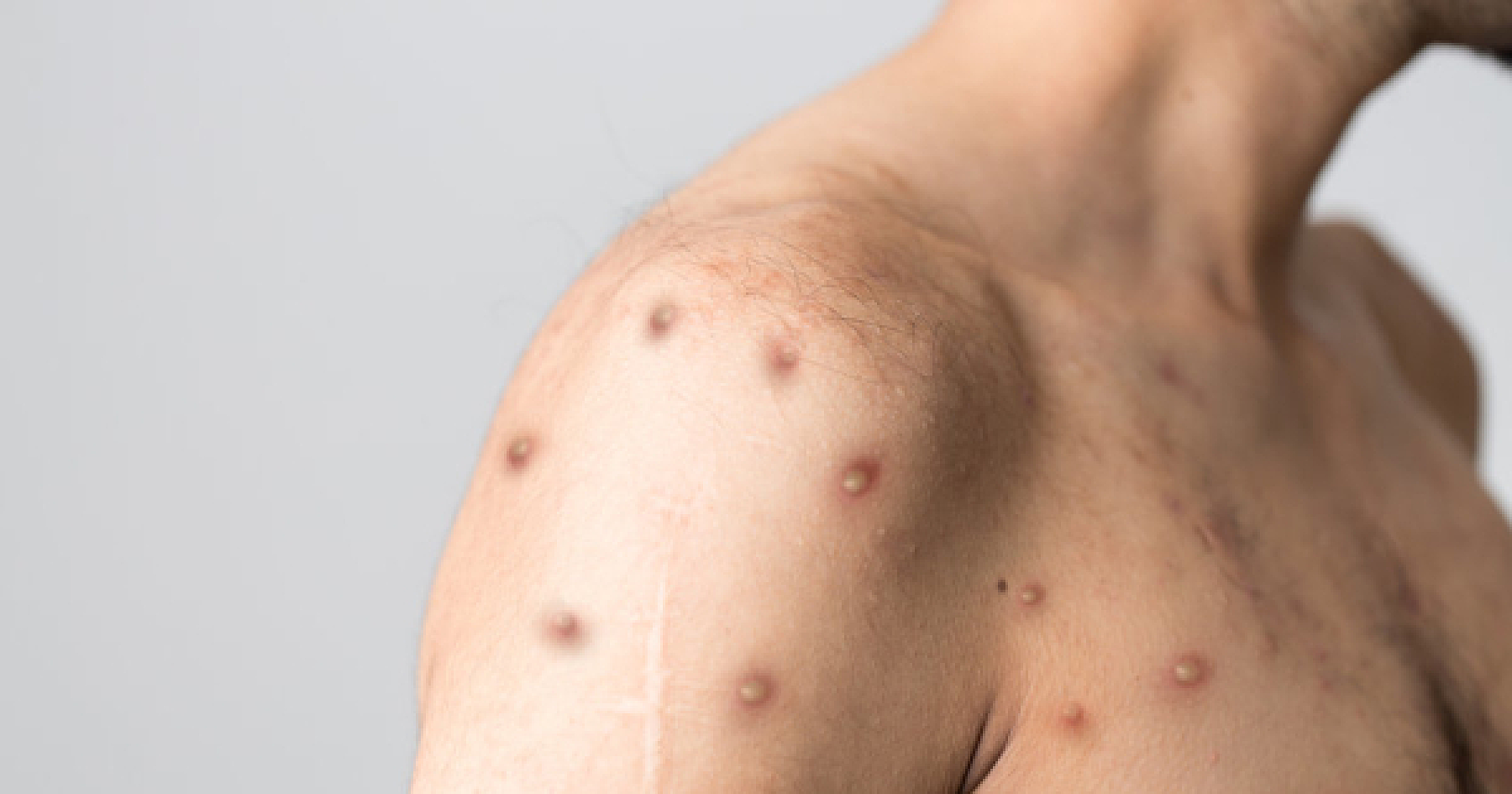 As Monkeypox Cases Spread, Report Shows Gates Foundation, WHO, Pharma Execs Took Part in Monkeypox Pandemic 'Simulation'