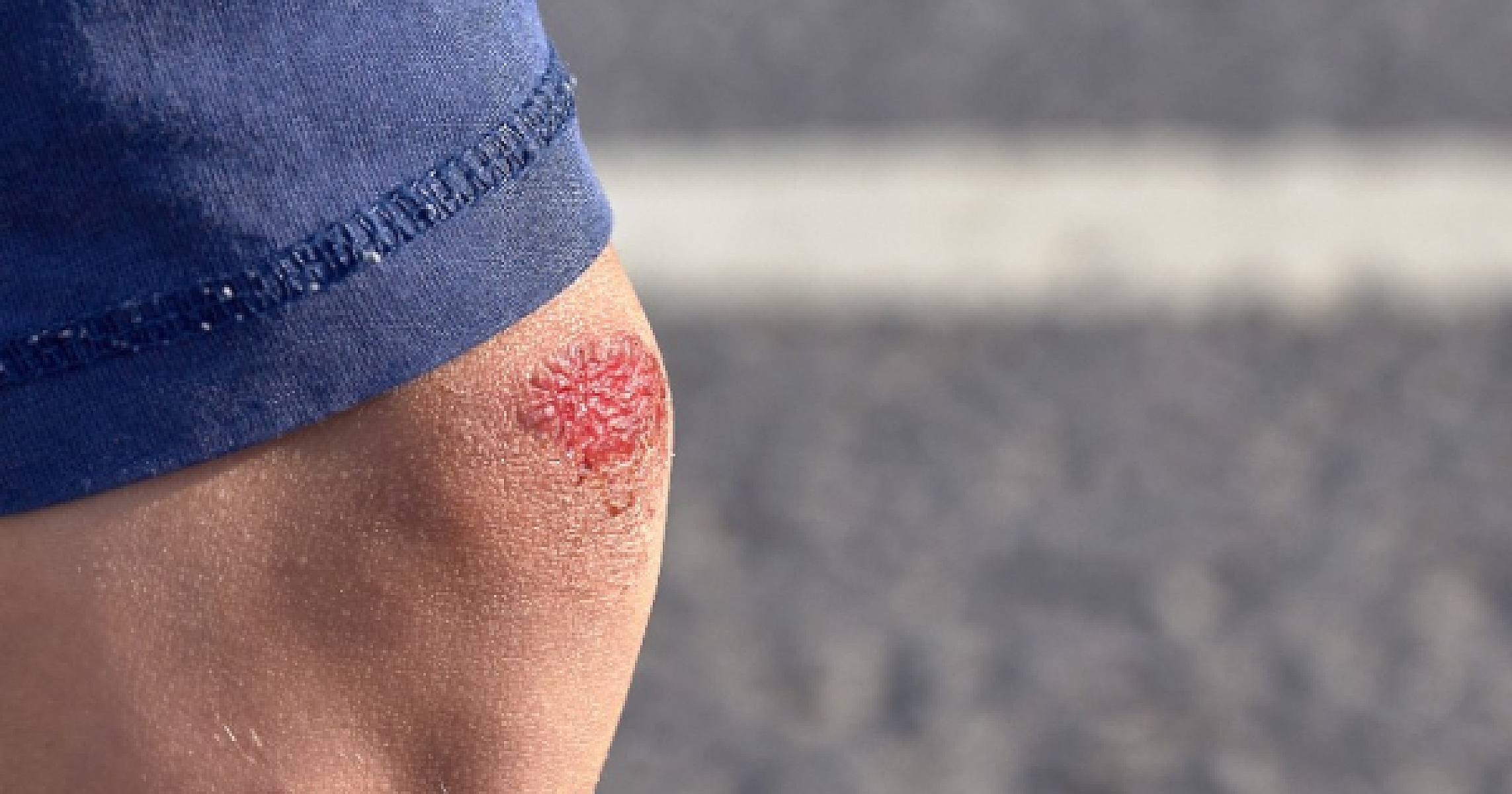 5 Science-Backed Wound Healers Found in Nature