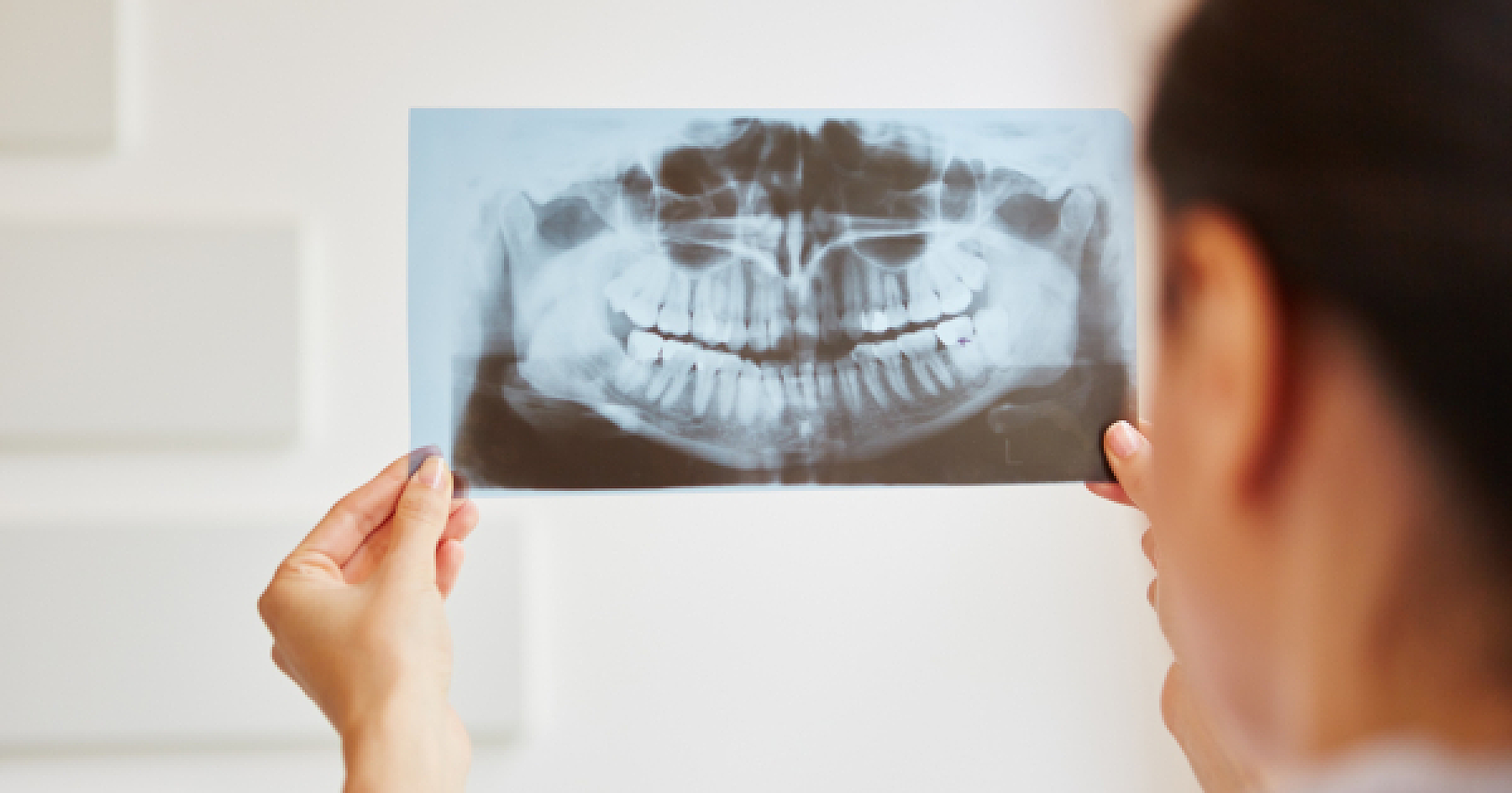 Is It Wise to Get Your Wisdom Teeth Pulled?