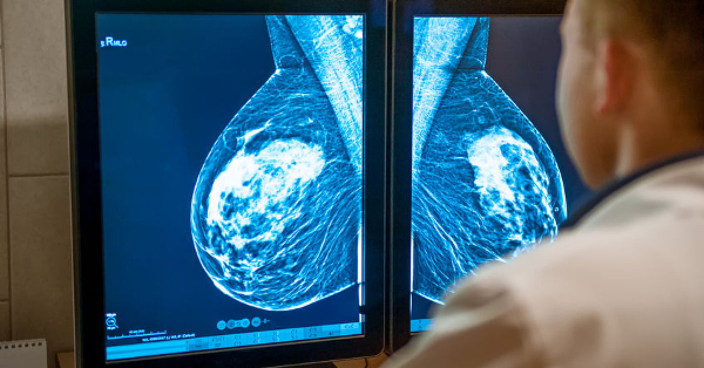 Mammography False-Positives Result in 84% Higher Rate of Breast Cancer Death, JAMA Oncology Reveals