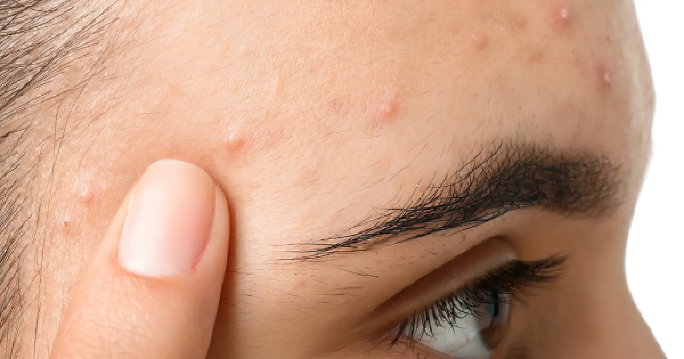 Skip Harmful Acne Drugs - Do This Instead for 76% Clear Skin