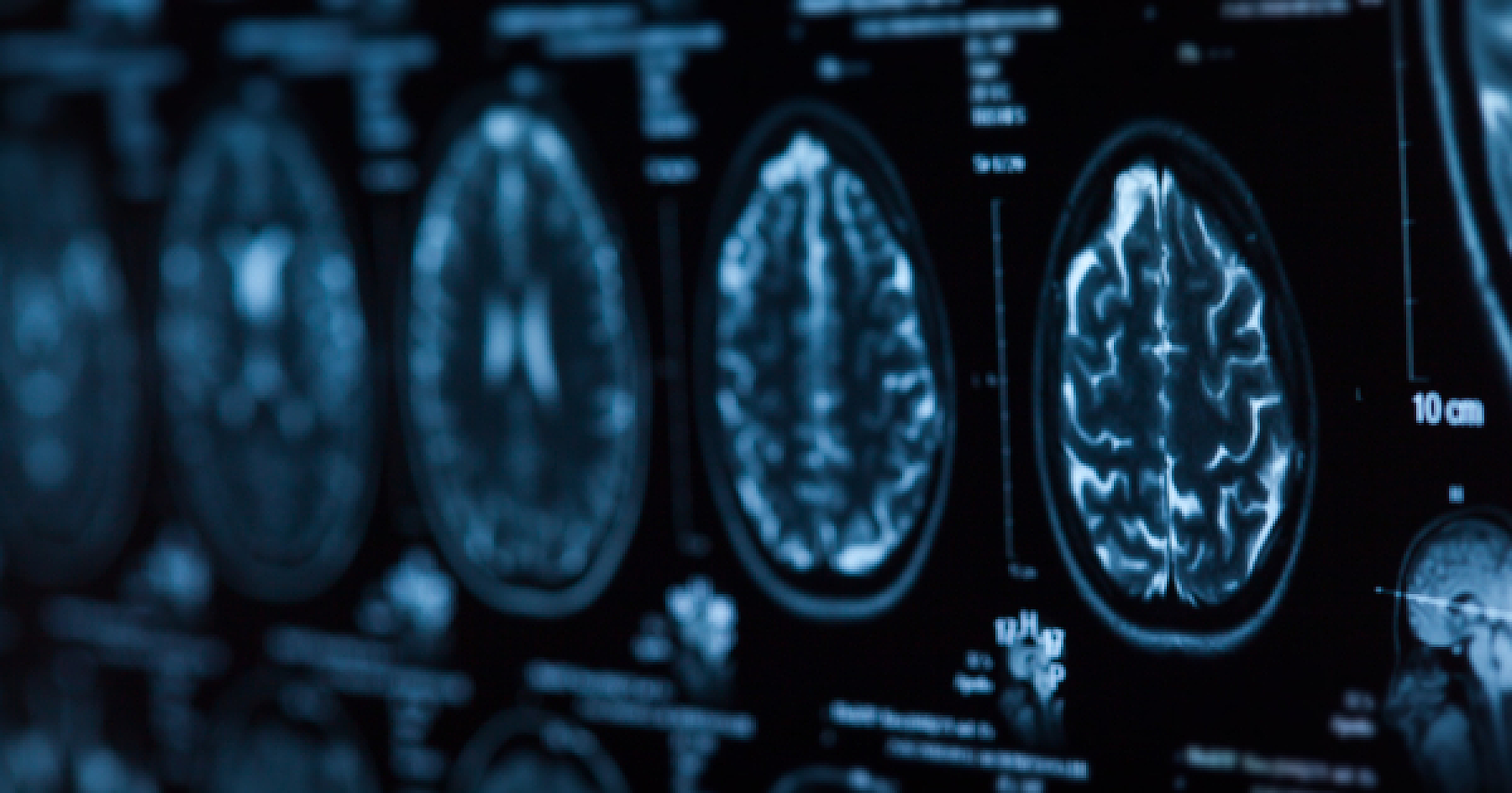 Nature's Solutions: 20 Natural Agents Backed by Science to Prevent and Aid Stroke Recovery