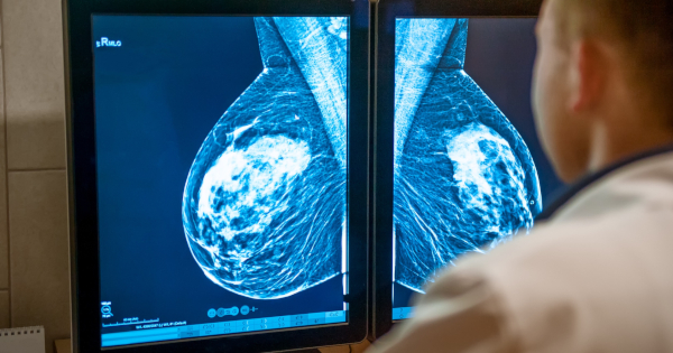 Xenoestrogens in the Air: The Hidden Culprits Behind Breast Cancer?