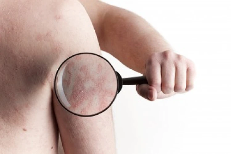 Does Ingesting GM Foods Create Disease, Such as Morgellons?