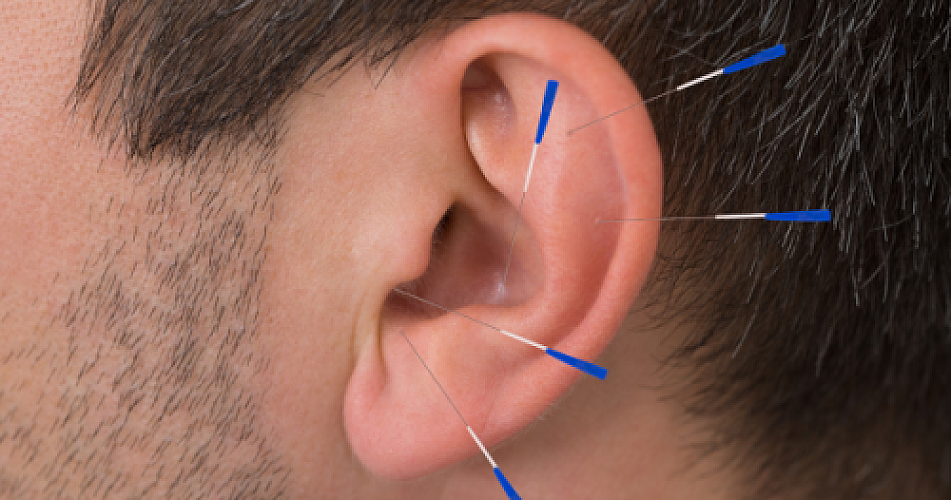 Pinpointing Hope: Auricular Acupuncture's Promise in Depression Treatment